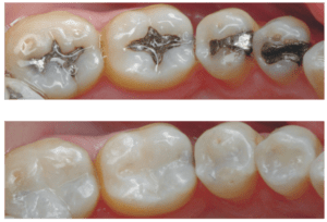 Composite Filling in arvada CO dentist