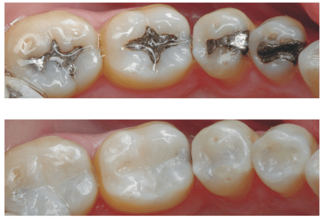 Composite Filling in arvada CO dentist