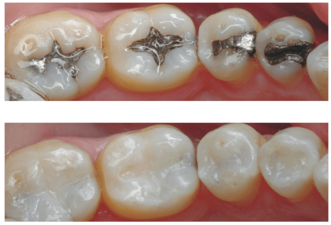 Composite Filling Before & After Photos