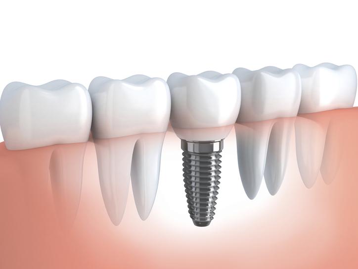Dental implant with Arvada Dentist at AFC Arvada Family and Cosmetic Dentistry