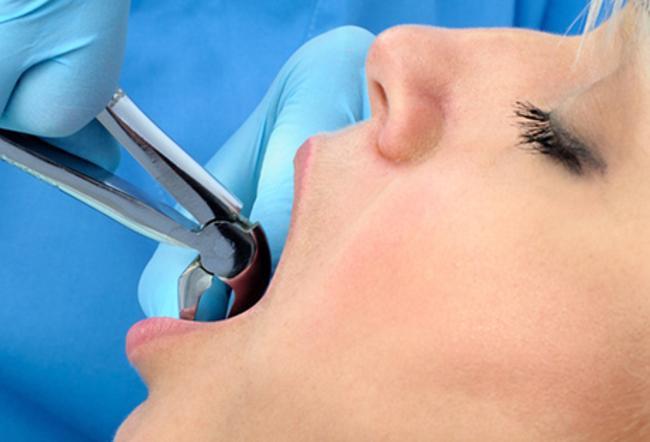 Extractions and Oral Surgery in Arvada, CO