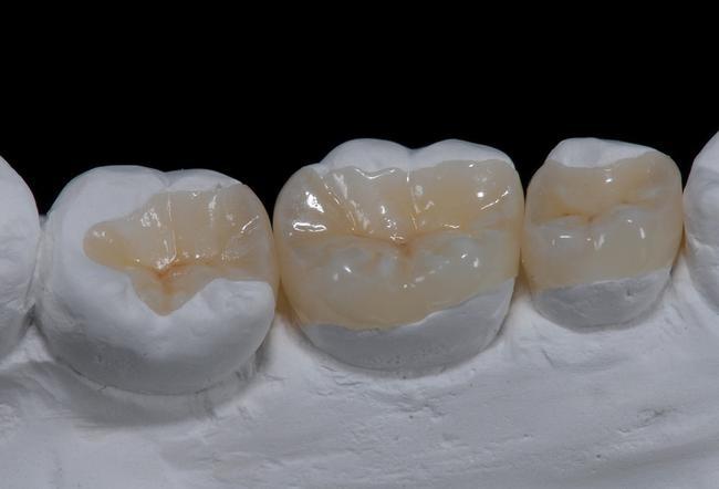 Dental Fillings, Inlays Onlays