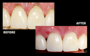 Pinhole®-Gum-Rejuvenation-Arvada-CO-Dentist