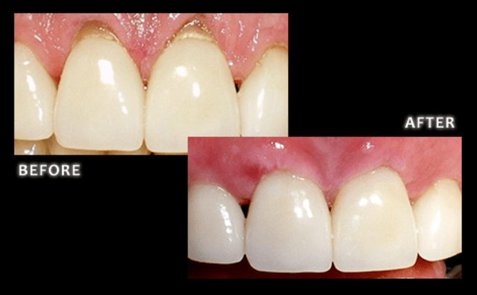 Pinhole®-Gum-Rejuvenation-Arvada Dentist at AFC Arvada Family and Cosmetic Dentistry