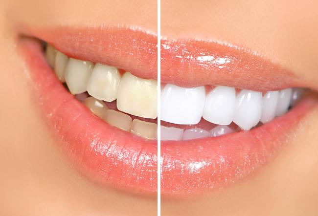 Free Teeth Whitening by Arvada Dentist at AFC Arvada Family and Cosmetic Dentistry