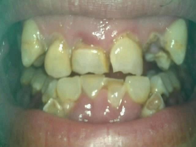 before-teeth