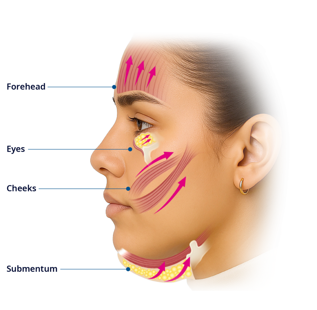EmFace Facial Rejuvenation - Arvada Dentist Near Me - AFC Dentistry - Emergency Dentist Near Me - Arvada Family & Cosmetic Dentistry